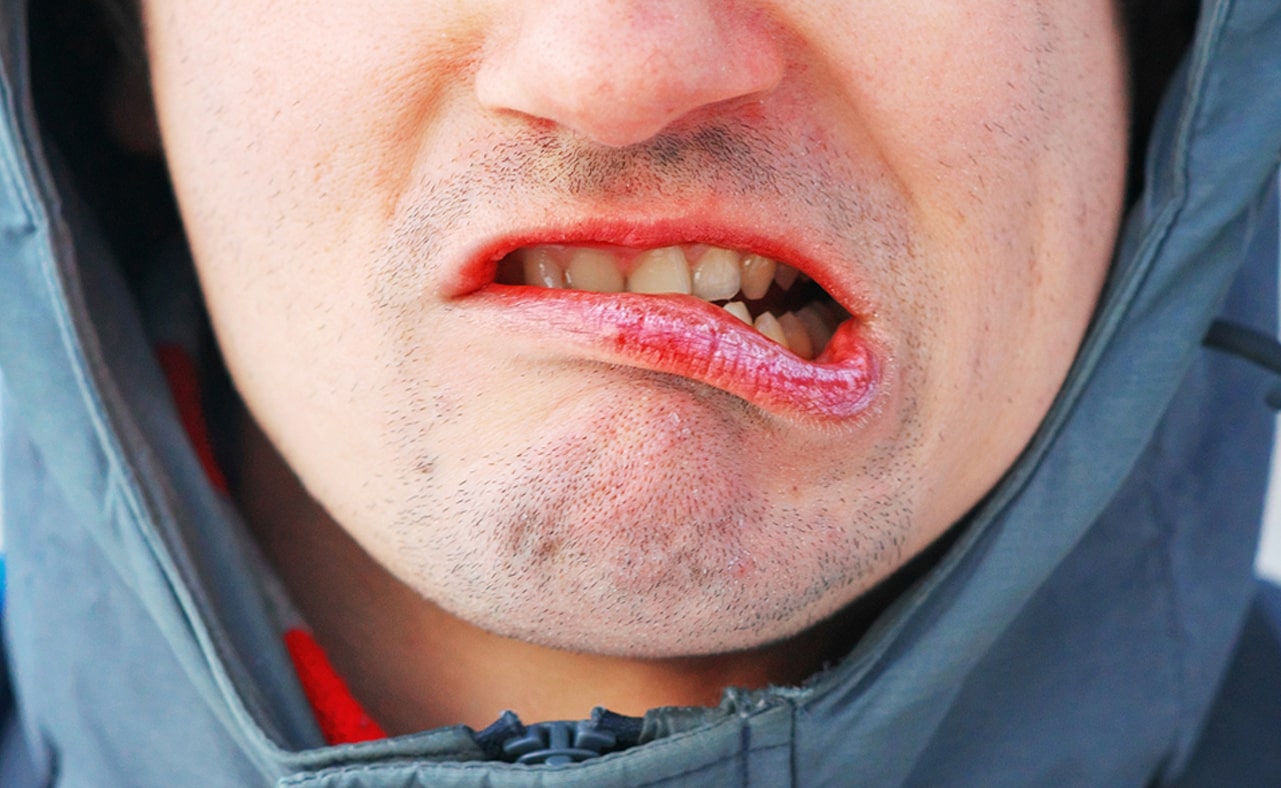 6 Ways to Help Chapped Lips
