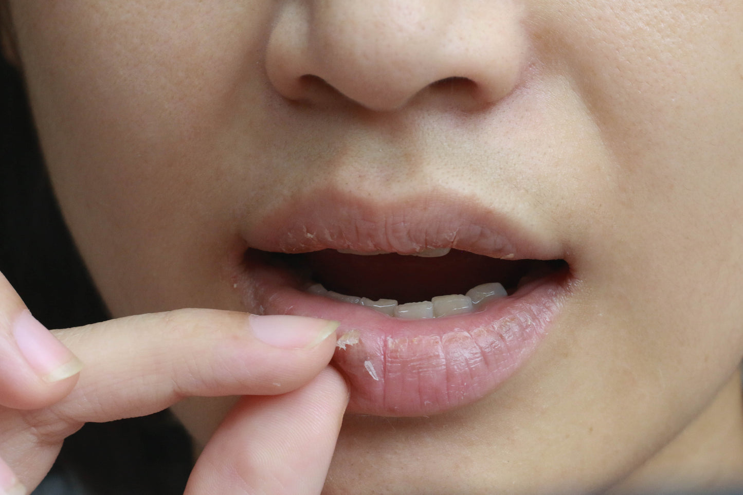 Everything You Need to Know About Chapped Lips – Chapstick SBC